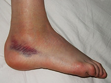 Sprained_foot